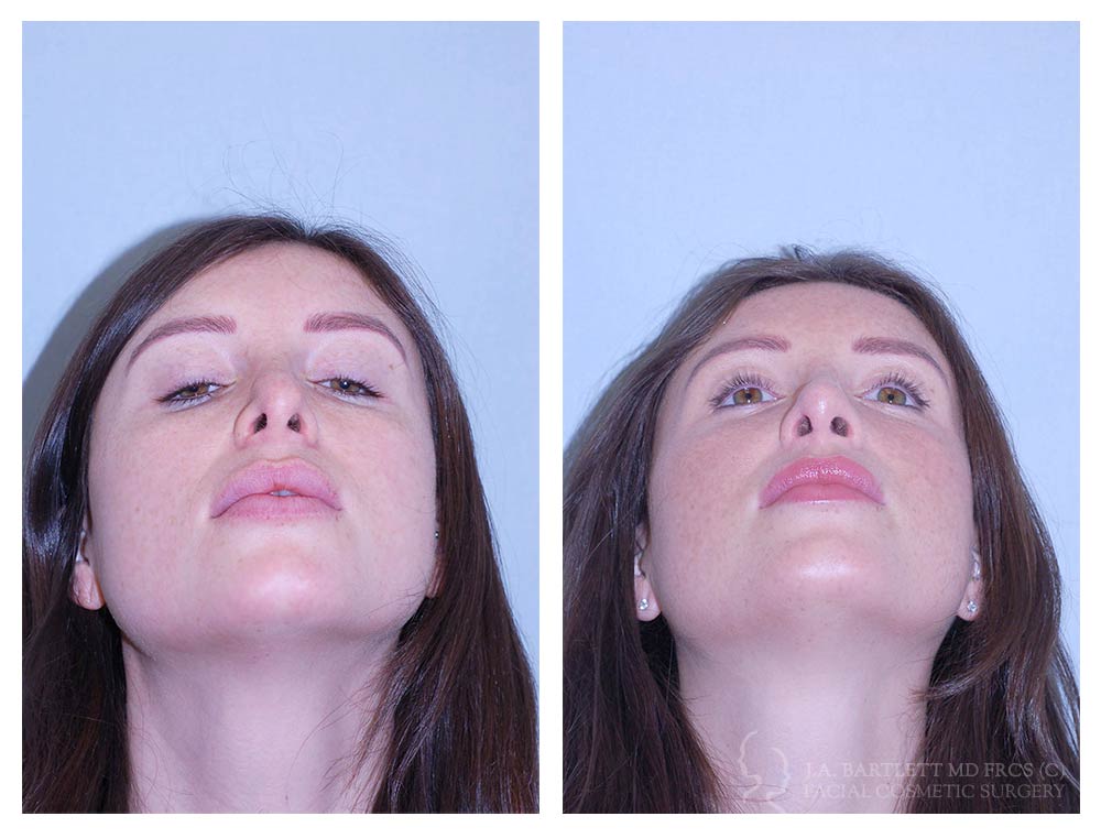 External Rhinoplasty - Revision case with Complex tip reconstruction (9 ...